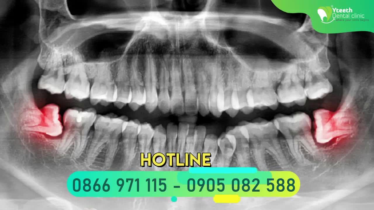 CHỤP PHIM XQUANG TRƯỚC KHI NHỔ RĂNG KHÔN CÓ CẦN THIẾT HAY KHÔNG