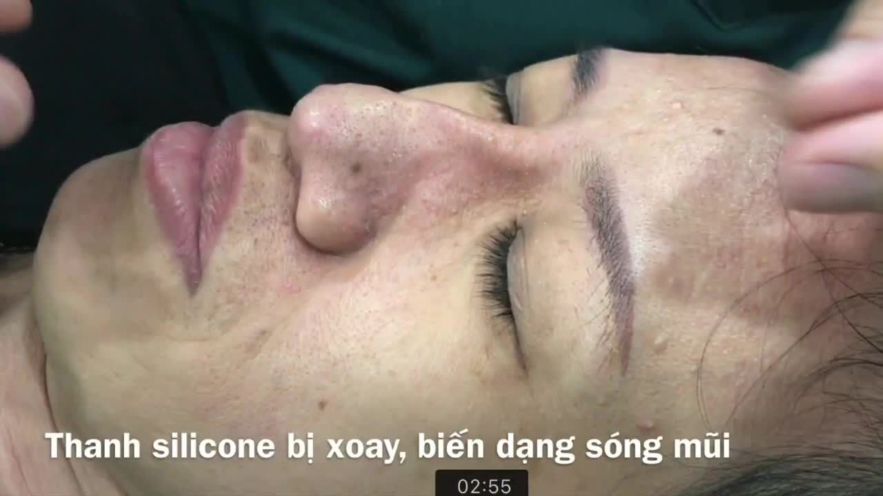 Chuyện là vầy, đôi khi có những bạn nâng mũi ở Charming được mấy ngày thấy sóng hơi lệch liền nhắn cho Charming: