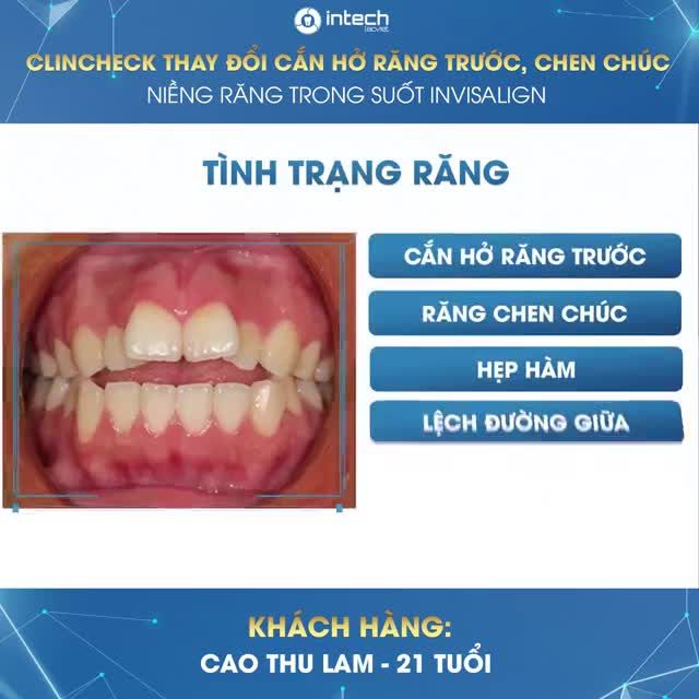 CLINCHECK NIỀNG RĂNG INVISALIGN KHÁCH HÀNG RĂNG CHEN CHÚC, CẮN HỞ