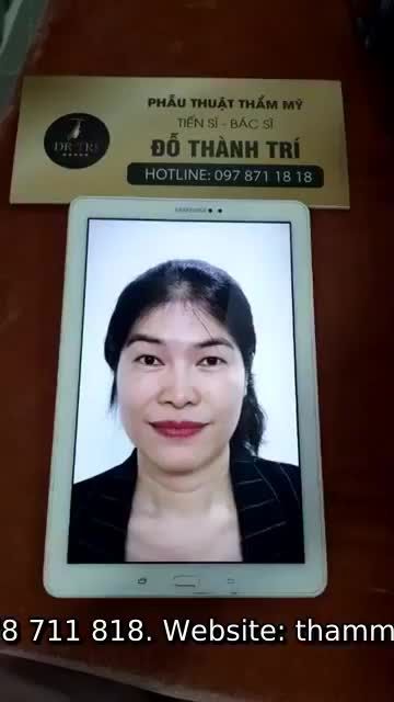 Dáng mũi đẹp xuất sắc sau 7 ngày nâng mũi.