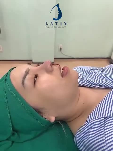 Dáng mũi Latin mềm mại tự nhiên, cải thiện ngay các khuyết điểm: