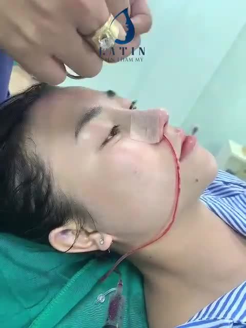 Dáng mũi thấp gãy, đầu mũi to, ngắn khiến khuôn mặt kém thanh thoát.
