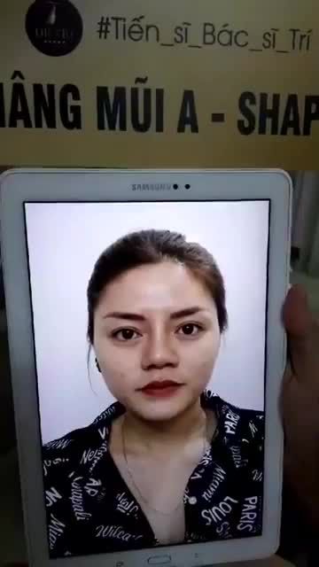 Đẹp tự nhiên với dáng mũi Ashape sau 1 tuần phẫu thuật.