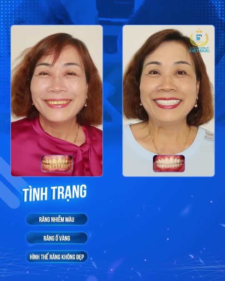 Điều gì khiến Vợ Chồng Chú Bích - Cô Thư từ Tp.HCM ra Hà Nội lựa chọn Nha khoa Quốc tế Việt Đức thẩm mỹ răng?