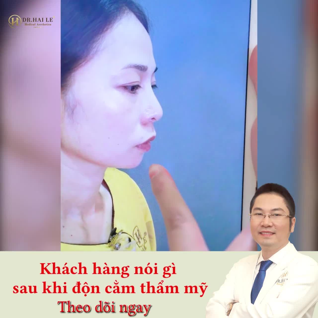 ĐỘN CẰM V-LINE - ĐẸP NGAY SAU KHI THỰC HIỆN.!!