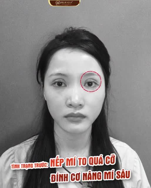 Dr.Hải Lê - Giải cứu mọi ca mí lỗi, hỏng