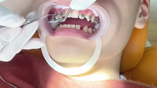 Gắn mắc cài cho khách hàng răng KHẤP KHỂNH