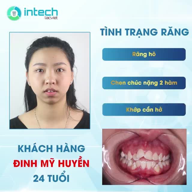 HÀNH TRÌNH LỘT XÁC NHỜ NIỀNG RĂNG CỦA KHÁCH HÀNG TẠI HỆ THỐNG NHA KHOA LẠC VIỆT INTECH