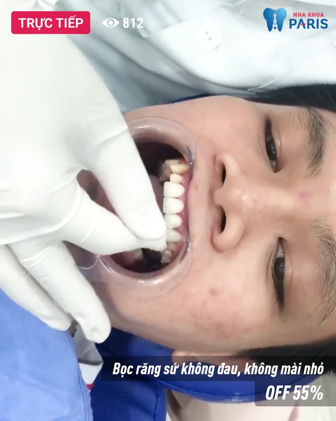 Hết răng nhiễm màu chỉ sau 2 ngày