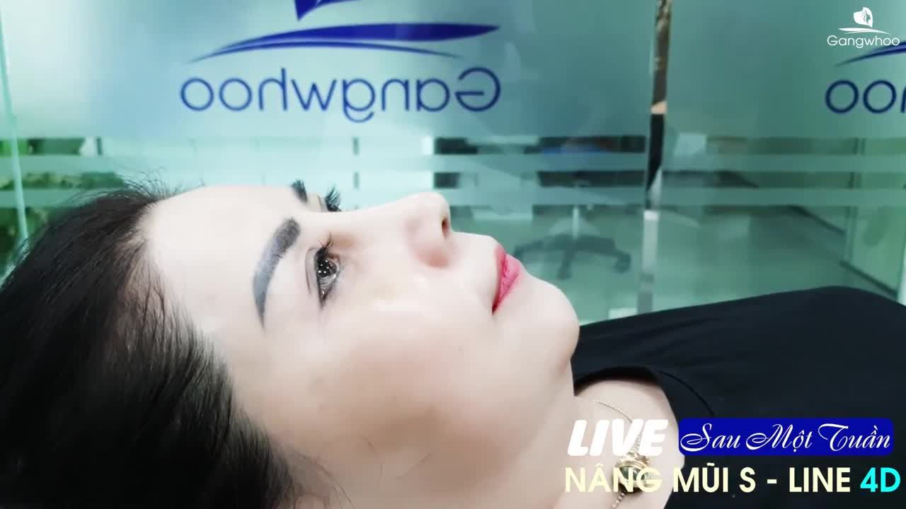 HÌNH ẢNH SAU 1 TUẦN NÂNG MŨI S-LINE 4D …