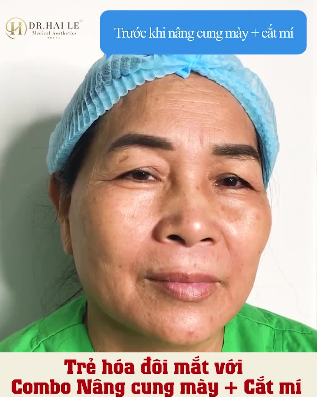 Hồi trẻ mắt cũng 2 mí đó, mà lúc có tuổi nó cứ sụp dần rồi thành sụp mí nặng như vậy.