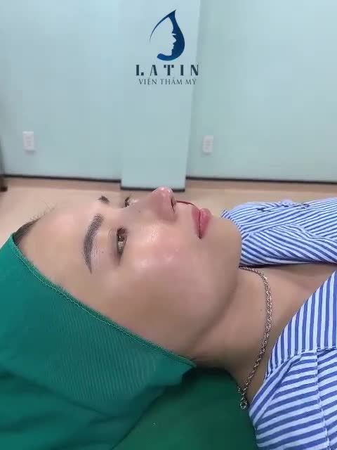 Kết quả ca mũi cấu trúc sóng surgiform, trụ tnr mesh, dáng mũi latin độc quyền bác sĩ vừa thực hiện xong, gửi tới cả nhà cùng chiêm ngưỡng ạ.