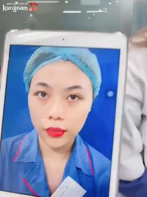 Kết quả ca NÂNG MŨI CẤU TRÚC 4D + CUỘN CÁNH MŨI thần thánh