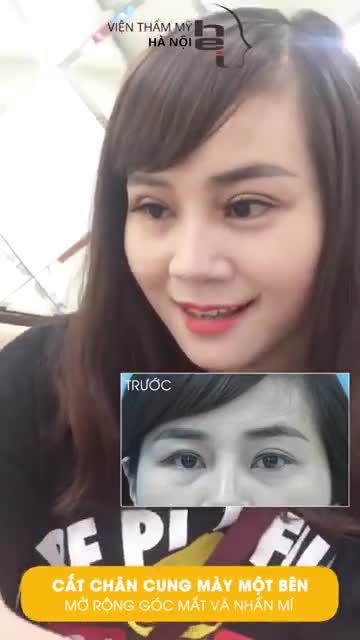KẾT QUẢ KHÁCH HÀNG THỰC HIỆN COMBO NHẤN MÍ + MỞ GÓC MẮT+ CẮT CHÂN MÀY SAU 09 NGÀY ĐẸP MĨ MÃN