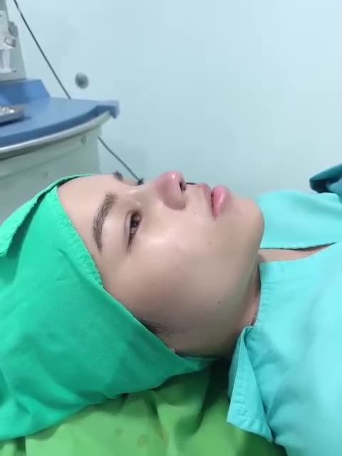 Kết quả mũi nâng cấu trúc trên nền xương bè rộng, mũi thấp gãy, đầu mũi cánh mũi to,...
