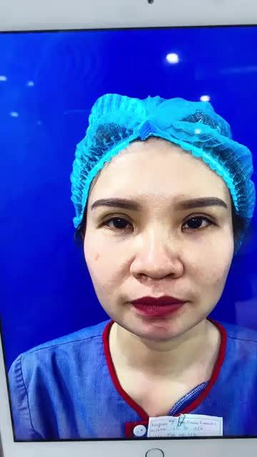 Kết quả nâng mũi cấu trúc 4D tại Bvtm kangnam