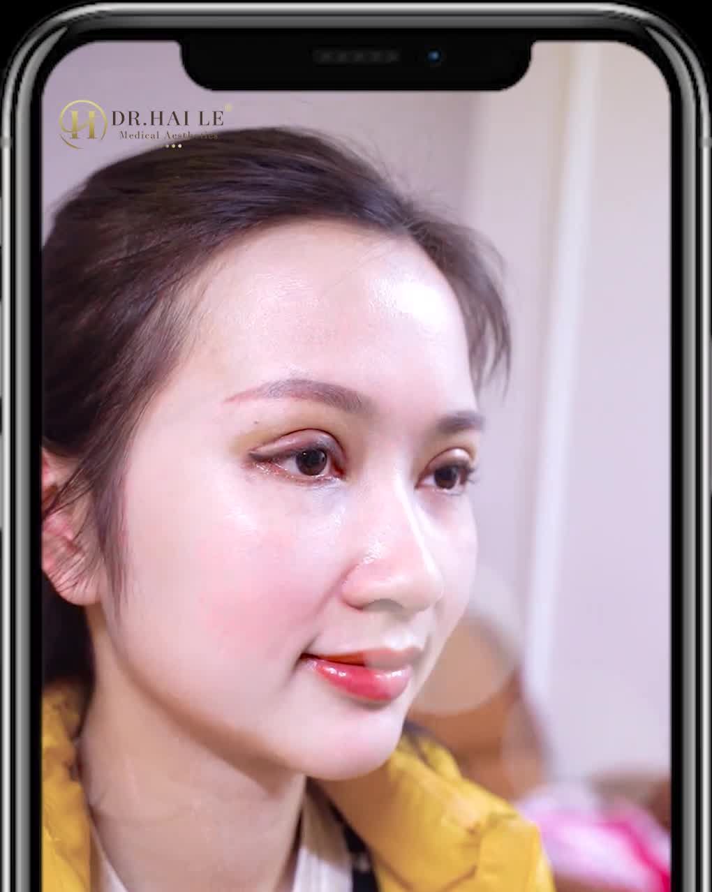 kết quả sửa mí sau 7 ngày tại Dr.Hải Lê