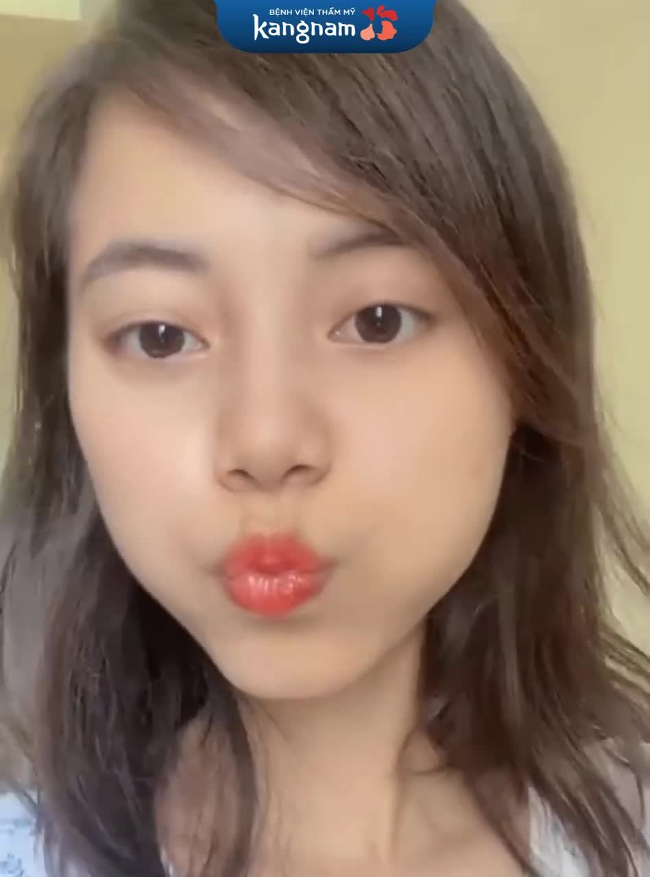 Kết quả TẠO HÌNH MÔI TIM sau 1 tháng đây ạ!