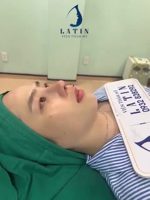 Kết quả thay đổi tuyệt vời cho bạn gái sau chưa đầy 2 tiếng nâng mũi cấu trúc surgiform chỉnh lệch.
