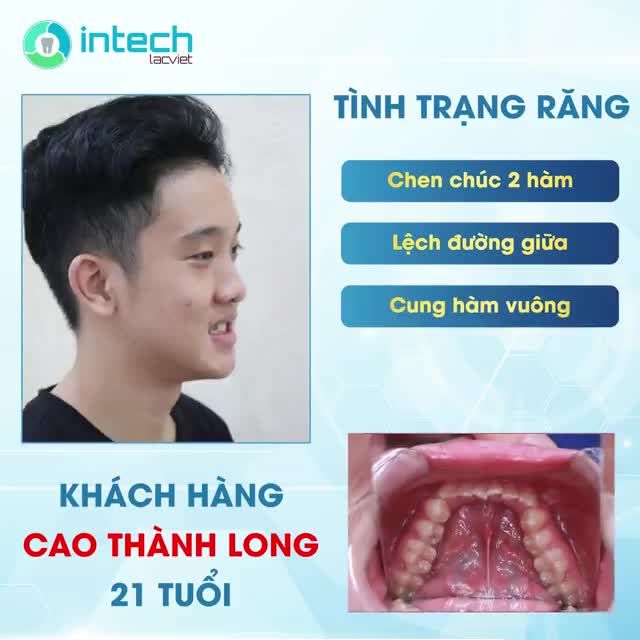 KHẮC PHỤC HÀM RĂNG KHẤP KHỂNH BẰNG PHƯƠNG PHÁP NIỀNG RĂNG