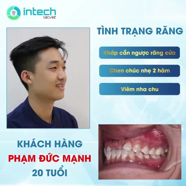 KHẮC PHỤC TÌNH TRẠNG KHỚP CẮN NGƯỢC NHỜ PHƯƠNG PHÁP NIỀNG RĂNG MẮC CÀI KIM LOẠI