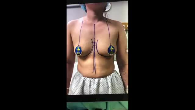 Khách hàng nâng ngực NanoChip size 265