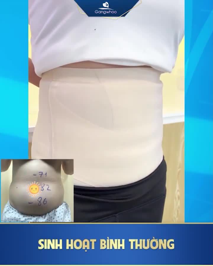 KHÁCH HÀNG NÓI GÌ VỀ CÔNG NGHỆ GIẢM MỠ LIPO