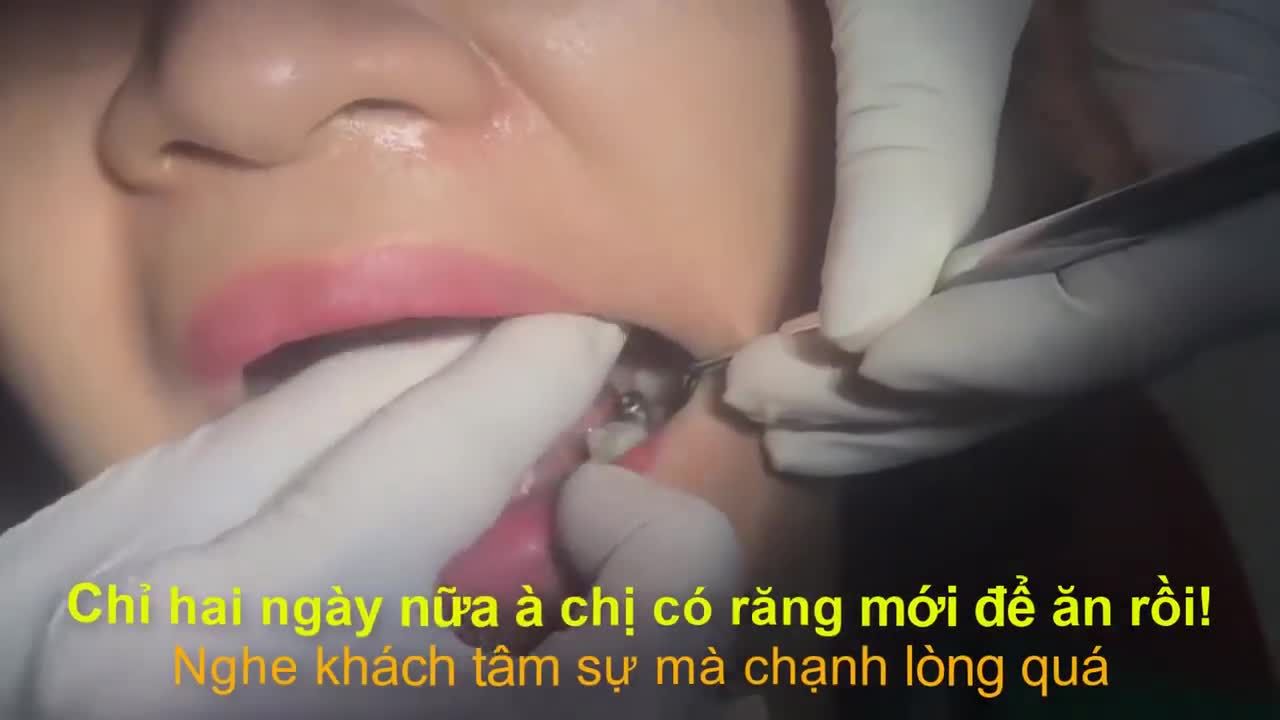 KHUYẾT ĐI MỘT CHIẾC RĂNG LÀ KHUYẾT ĐI MỘT PHẦN NỤ CƯỜI