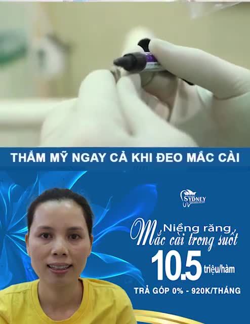 LƯU Ý TRONG QUÁ TRÌNH NIỀNG RĂNG