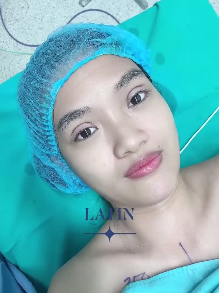 Mắt 2 mí sắc nét ngay sau pt cắt mí 4D.