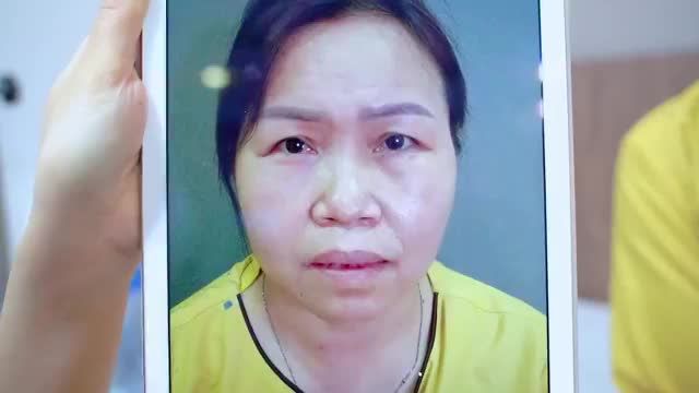 Mắt sụp mí tuổi trung niên gây nặng mắt, che khuất tầm nhìn, "mắt cau mày có" trông già nua... phải khắc phục như thế nào?