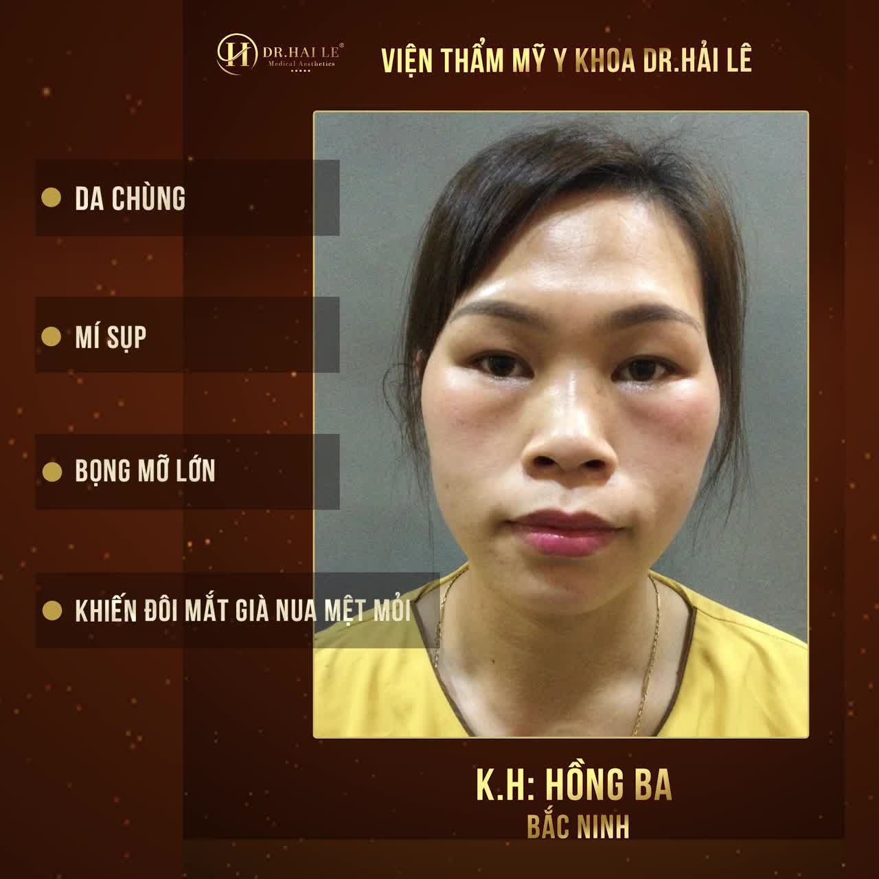 MÍ MẮT DƯỚI của bạn có giống với vị khách hàng này của chúng tôi không?