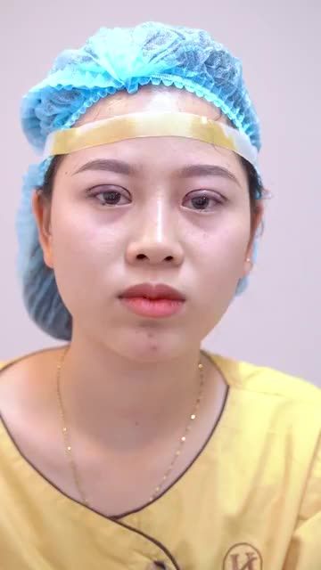 Mí mắt lỗi hỏng do PTTM chưa đẹp, chưa thành công bạn đến ngay Dr.Hải Lê để có phương pháp chỉnh hình khắc phục mí mắt đẹp tự nhiên trở lại nhé