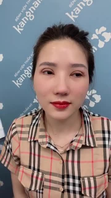 MÍ MŨI Đẹp chuẩn Hàn với Chi phí "này" có làm chị em điêu đứng?