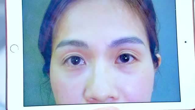 Mí sậu, nhiều nếp gấp, da chùng già nua... vị khách hàng quyết tâm Cắt mí để cải thiện
