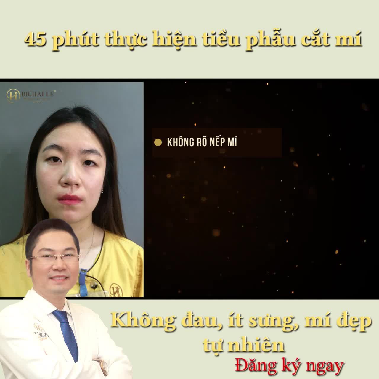 "Mình có dự định làm mí khá lâu rồi, nhưng để chắc chắn mình tìm hiểu rất kỹ mới quyết định tới Dr.Hải Lê bởi là địa chỉ nổi tiếng uy tín, ngay sau khi thực hiện mình đã rất vui và nghĩ sự lựa chọn của mình thực sự rất đúng đắn..."