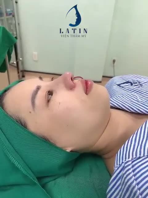 Mời cả nhà cùng theo dõi kết quả ca mũi sửa lại cấu trúc, cuốn cánh mũi, xử lý khuyết điểm sẹo đầu mũi cho bạn gái từng nâng 1 lần ở cơ sở thẩm mỹ khác nhưng không thành công nhé!
