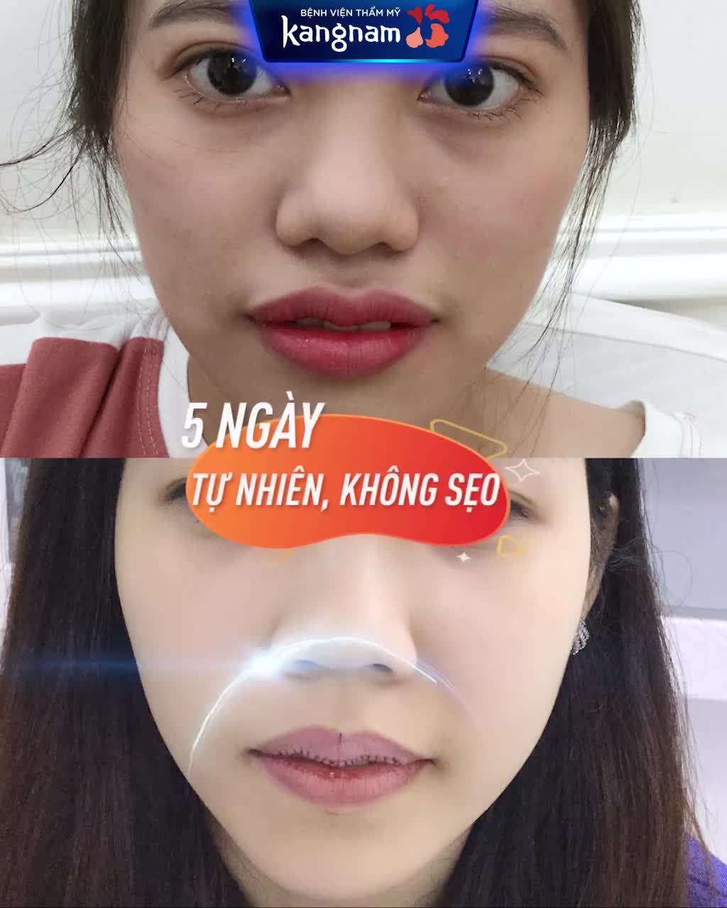 Môi DÀY/TRỀ/LỆCH Sao chưa THU MỎNG MÔI?