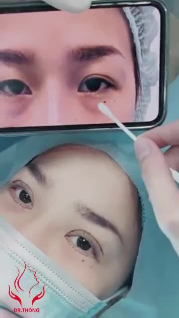 MỤC SỞ THỊ CA CẮT MÍ TRÊN DƯỚI VỪA THỰC HIỆN XONG