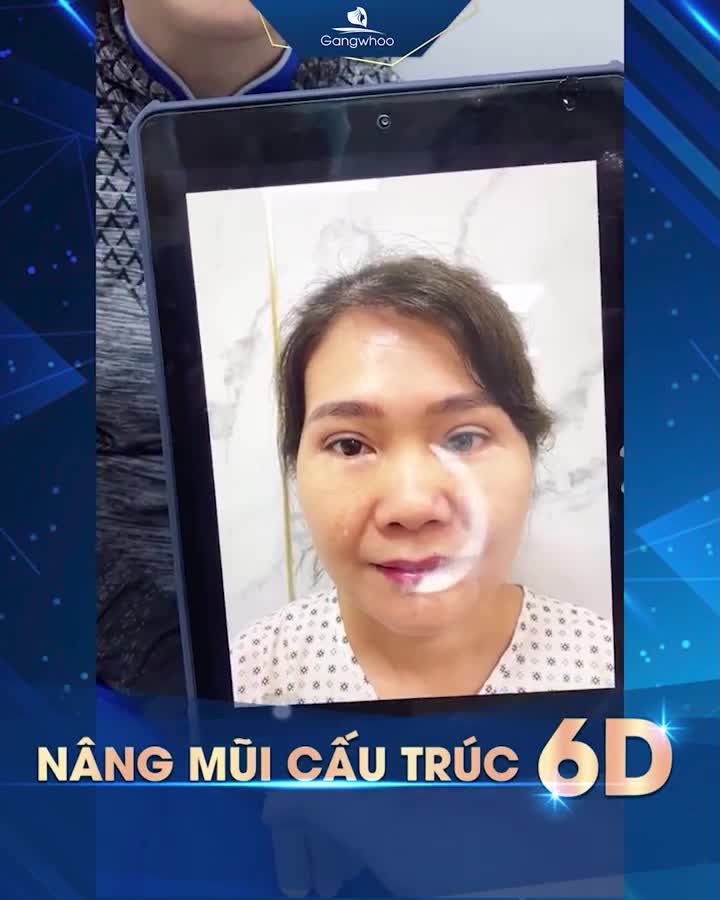 MŨI CẤU TRÚC 6D CHƯA BAO GIỜ LÀM BẠN THẤT VỌNG