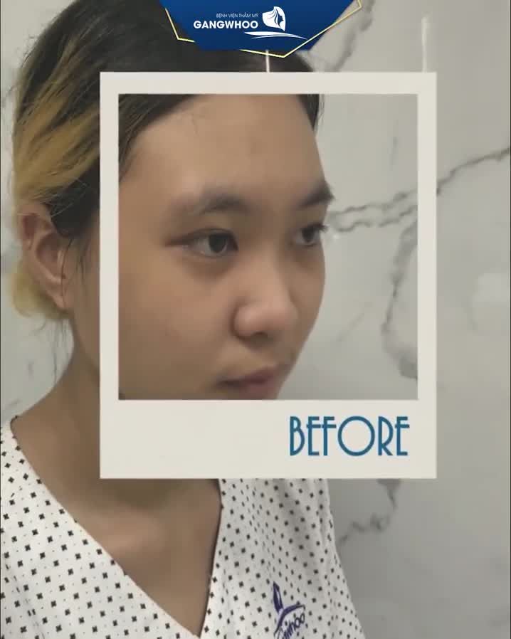MŨI ĐẸP RẠNG NGỜI – NÂNG TẦM NHAN SẮC