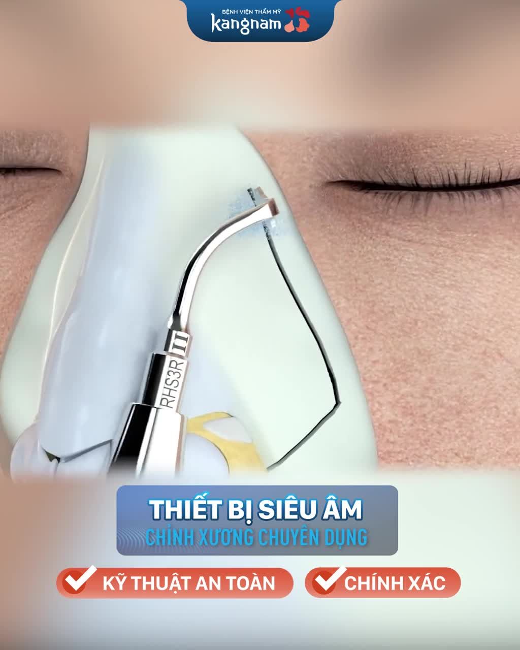 Mũi gồ/ mũi gãy/ xương mũi to bè - Muốn đẹp cần chỉnh xương mũi!!!!