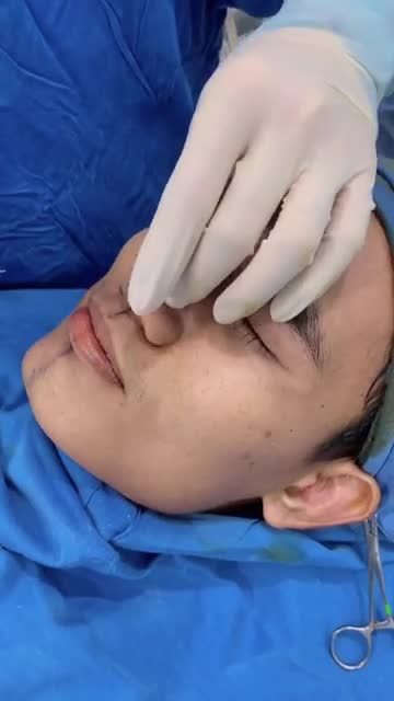 MŨI TO, CÁNH MŨI BÈ - Thu gọn mũi đẹp nam tính bằng cách nào?