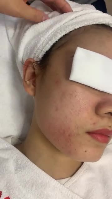 MỤN ẨN chi chít toàn gương mắt CHỮA ngay đi còn KỊP