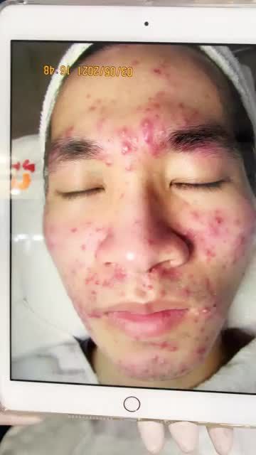 Mụn VIÊM bùng phát, kéo dài 2 năm