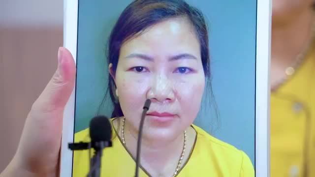 Nâng cung mày giải pháp giúp chị em phụ nữ khắc phục tình trạng da chùng sụp mí nặng mắt già nua hiệu quả