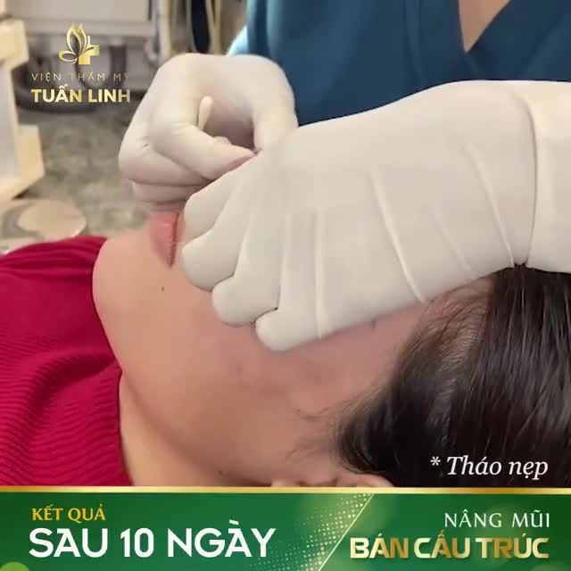 NÂNG MŨI BÁN CẤU TRÚC CHỈ 17TR500.