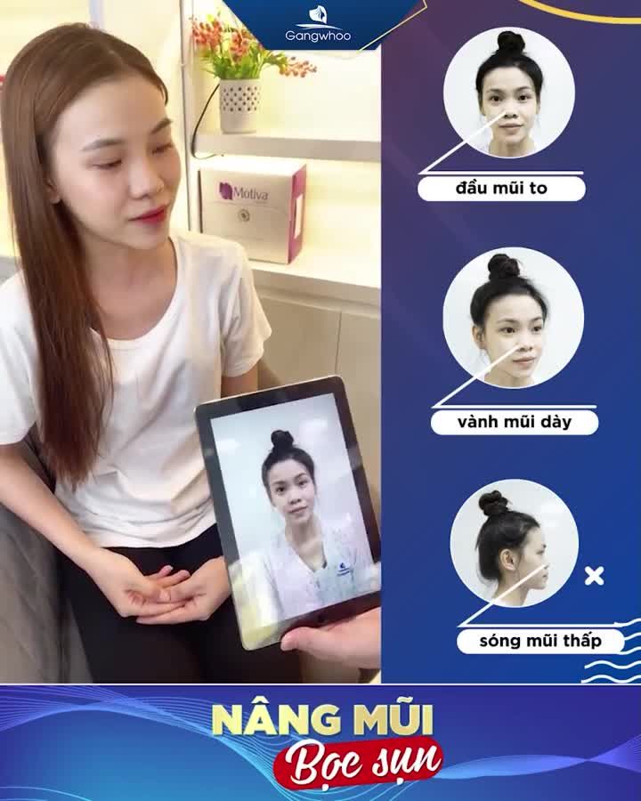 NÂNG MŨI BỌC SỤN – MỀM MẠI TỰ NHIÊN