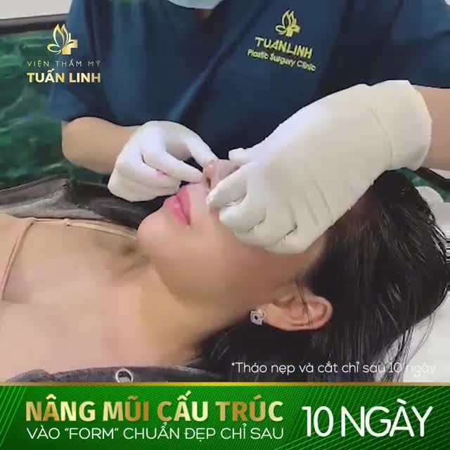 NÂNG MŨI CẤU TRÚC VÀO PHOM CHUẨN ĐẸP CHỈ SAU 10 NGÀY.