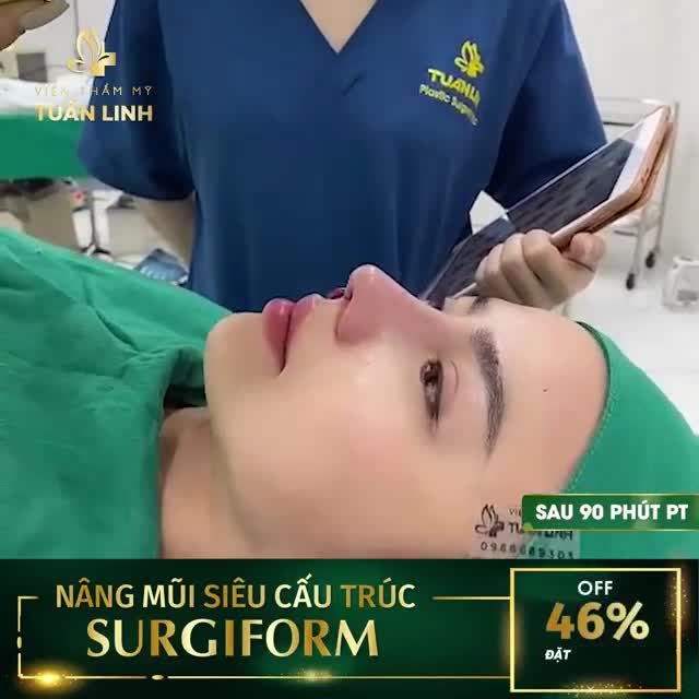 NÂNG MŨI SIÊU CẤU TRÚC SURGIFORM - TỰ NHIÊN NHƯNG VẪN ĐỦ ĐỘ CAO TÂY.